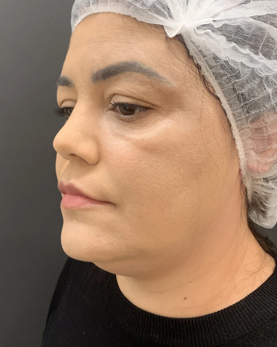 A mesma paciente após o tratamento de melasma na Skin House